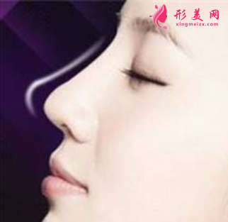 自體軟骨隆鼻后會(huì)有血腫嗎