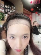 成都恒博發(fā)際線調(diào)整術(shù)后恢復(fù)情況反饋