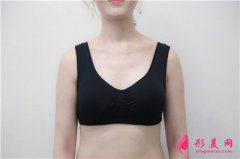 成都圣丹福整形美容醫(yī)院小姐姐假體隆胸術(shù)后效果展示