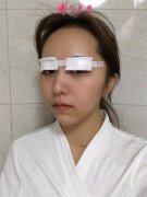 昆明市第一人民醫(yī)院星耀醫(yī)院切開(kāi)雙眼皮術(shù)后恢復(fù)情況分享