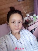 鄭州附二院小仙女鼻綜合術(shù)后效果圖分享