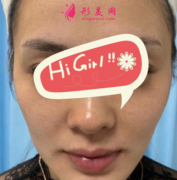 上海九院整形科熱瑪吉案例 越活越年輕 還有瘦臉提拉效果
