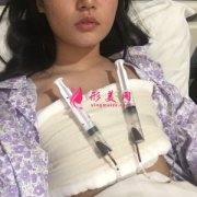 北京京民整形外科假體隆胸案例 性感迷人 告別“飛機場”