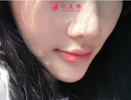注射瘦臉針會不會有副作用呢