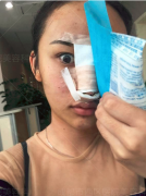 在成都西區(qū)醫(yī)院整形科做鼻綜合整形，大家都說效果很不錯~