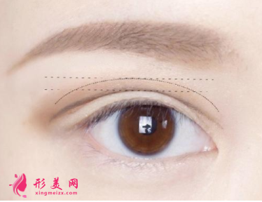 雙眼皮術(shù)后需要做好的護(hù)理工作