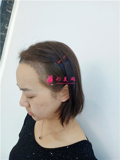 成都植發(fā)際線手術(shù)1900單位術(shù)后頭發(fā)生長(zhǎng)情況對(duì)比 術(shù)后 成都植發(fā)際線手術(shù)1900單位術(shù)后頭發(fā)生長(zhǎng)情況對(duì)比