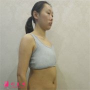 南京華美美容醫(yī)院假體隆胸手術術后恢復情況分享