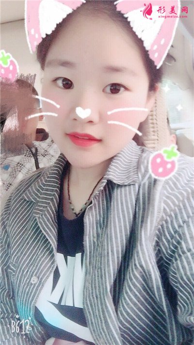 福州切開雙眼皮術(shù)后恢復(fù)情況分享