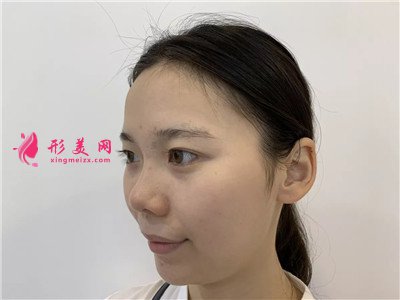 廣州小姐姐面部線雕提升術(shù)后效果分享