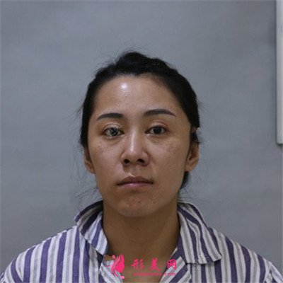 青島祛眼袋術后恢復效果反饋