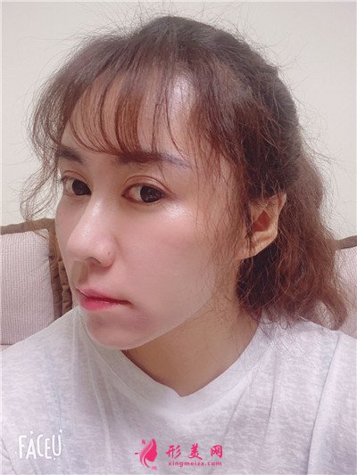 青島祛眼袋術后恢復效果反饋 術后 青島祛眼袋術后恢復效果反饋