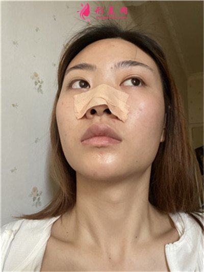 武漢硅膠假體隆鼻術(shù)后恢復情況分享