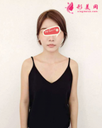 北京彤美醫(yī)療美容醫(yī)院假體隆胸真人實拍圖 手感很軟 女人味十足