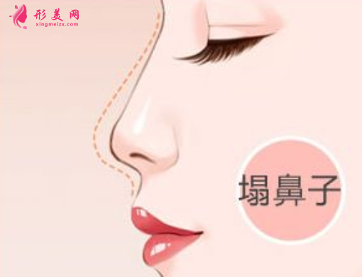 假體隆鼻多少天可以恢復