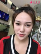 成都美容整形醫(yī)院小姐姐自體肋軟骨隆鼻術(shù)后效果展示