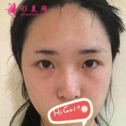 重慶軍科整形醫(yī)院假體隆鼻親身體驗(yàn) 鼻型立體很自然哦