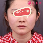 上海九院下頜角磨骨恢復(fù)過程圖 再也不是路人臉了