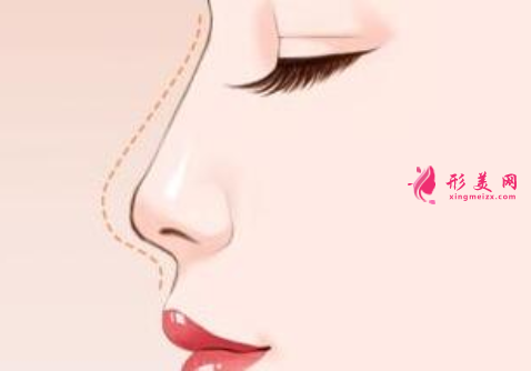 隆鼻假體取出后會(huì)怎么樣