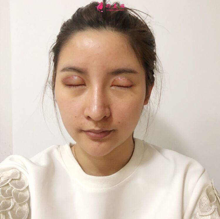 術(shù)后第一天