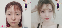 自體脂肪填充全臉效果怎么樣，60天恢復(fù)實(shí)例