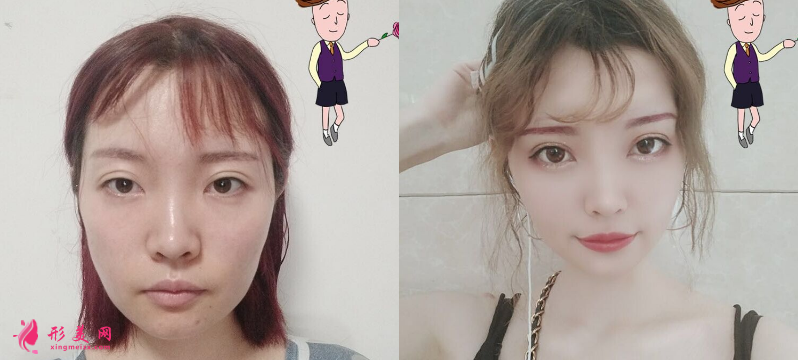 手術前后對比