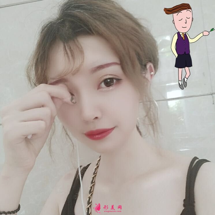 自體脂肪填充