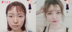 自體脂肪填充全臉效果怎么樣，60天恢復(fù)實(shí)例