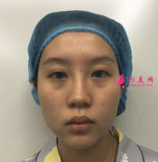 在天津伊頌整形做眼部多項(xiàng)怎么樣？術(shù)后80天真實(shí)案例效果分享