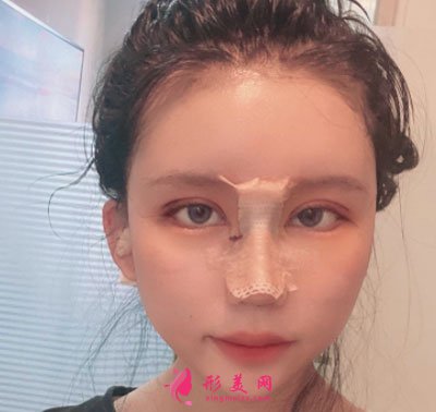天津伊頌整形眼部整形案例