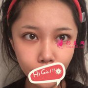 西安美萊整形醫(yī)院鼻綜合整形后任何角度都好美 鼻型很自然