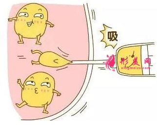 做腰腹部吸脂后影響懷孕嗎