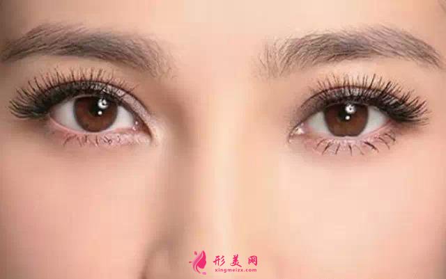 切開(kāi)雙眼皮術(shù)后吃什么比較好