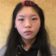 成都中醫(yī)大銀海醫(yī)美切開雙眼皮術(shù)后恢復(fù)情況分享