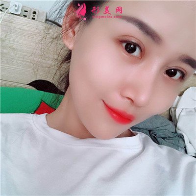 長春自體肋軟骨隆鼻術(shù)后效果分享 術(shù)后 長春自體肋軟骨隆鼻術(shù)后效果分享