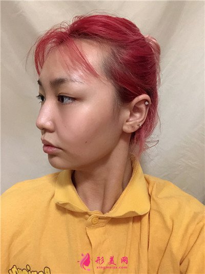 南京吸脂瘦臉術(shù)后恢復(fù)效果反饋