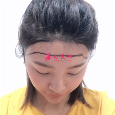 廣州新生種植發(fā)際線手術(shù)術(shù)后效果分享