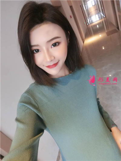廣州新生種植發(fā)際線手術(shù)術(shù)后效果分享 術(shù)后 廣州新生種植發(fā)際線手術(shù)術(shù)后效果分享