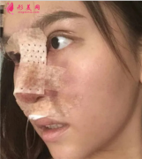 成都軍大醫(yī)院鼻綜合案例分享，術(shù)后秒變小美女~