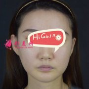在武漢華美整形醫(yī)院做了面部吸脂后效果驚呆了