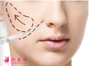 玻尿酸填充臉部怎么消腫