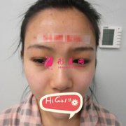 大連新華美天整形醫(yī)院假體隆鼻案例 和天生的一樣 側(cè)臉絕了