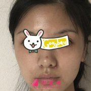 廣州凱美達(dá)整形醫(yī)院光子嫩膚術(shù)前后對(duì)比圖 皮膚很有光澤哦