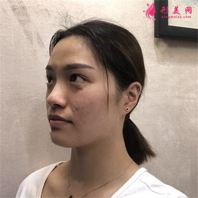 杭州光子嫩膚恢復(fù)情況反饋
