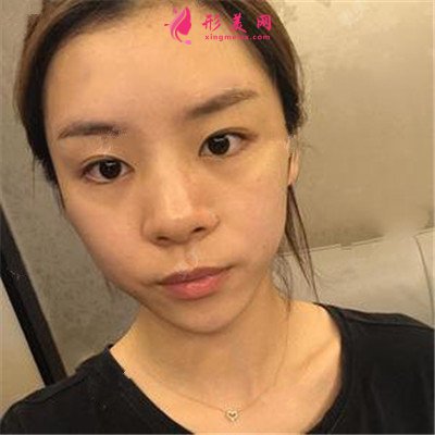 重慶膨體隆鼻術(shù)后恢復(fù)情況對(duì)比圖分享
