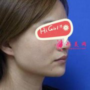 西寧華美整形醫(yī)院下頜角磨骨真實(shí)案例 即現(xiàn)精致小V臉