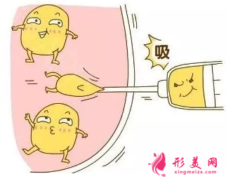 腹部吸脂術(shù)后要怎么護理