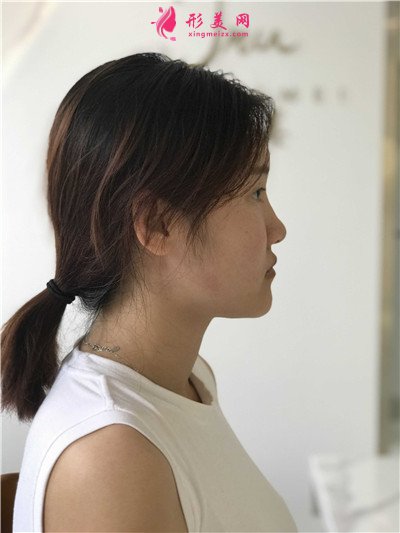 長春鼻綜合手術(shù)術(shù)后效果反饋