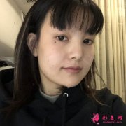 成都武侯蓉美和諧小姐姐吸脂瘦臉術(shù)后恢復(fù)情況反饋
