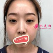 在濟(jì)南瑞麗醫(yī)療美容醫(yī)院做假體隆鼻后悄悄變美 太自然了吧